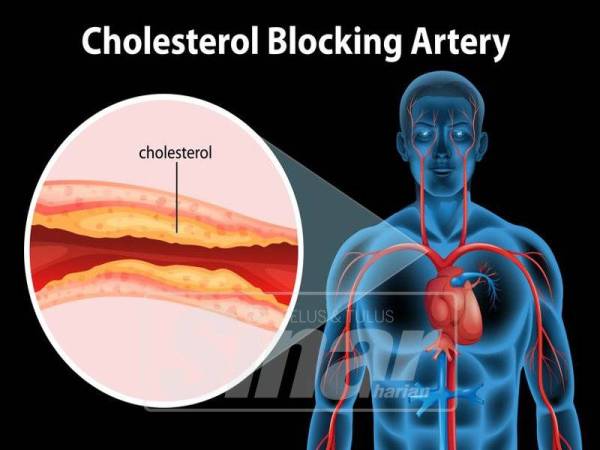 KOLESTEROL yang tinggi boleh menyebabkan arteri darah tersumbat hingga menjejaskan jantung.
