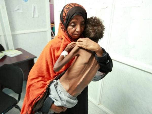 Seorang wanita mendukung anaknya yang dirawat di sebuah klinik akibat kekurangan zat disebabkan konflik berterusan di Yaman.