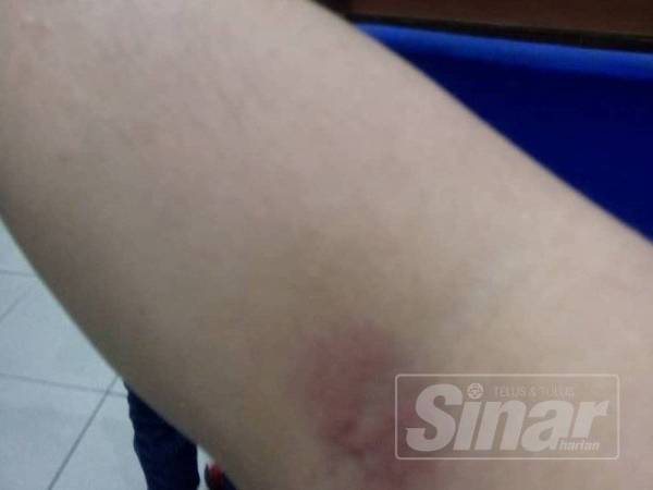 Tangan Firman kelihatan merah seperti ruam sewaktu mula-mula terkena bisa charlie.