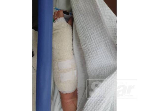 Kedua-dua tangan mangsa cedera selepas terkena asid yang disimbah dua suspek.