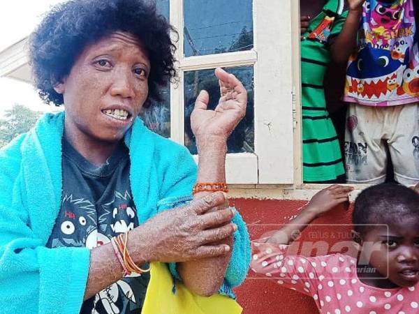  Wanita  Orang  Asli  derita penyakit kulit kronik kembali pulih