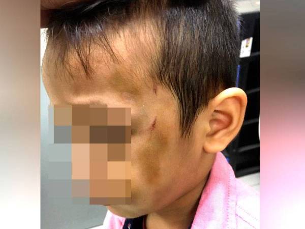 Kesan lebam pada wajah mangsa