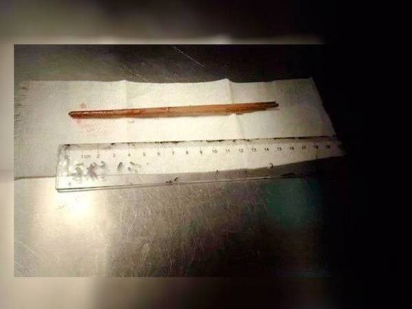 Penyepit makanan berjaya dikeluarkan oleh doktor yang memberikan rawatan kepada bayi tersebut.