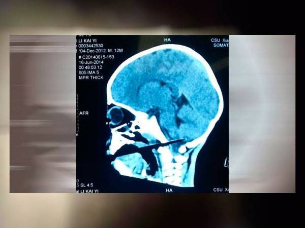Laporan X-ray menunjukkan penyepit makanan hampir terkena pada bahagian otak bayi tersebut.