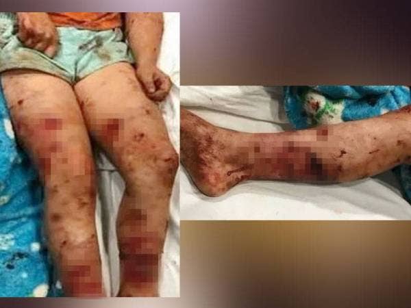 Seorang budak perempuan dari Amerika Syarikat mengalami kecederaan teruk selepas diserang tiga ekor anjing yang terlepas dari tempat perlindungan haiwan. - Foto Agensi