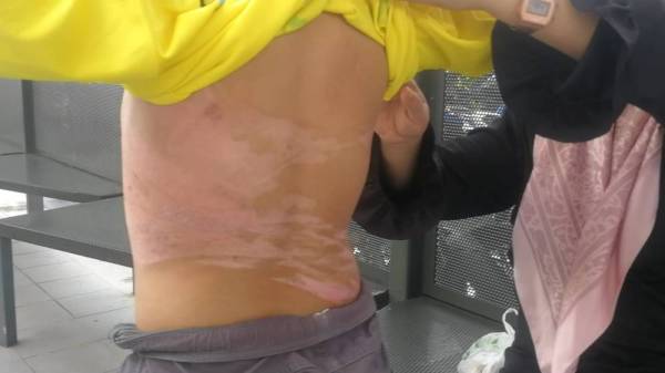 Siti Satariah menunjukkan bahagian belakang Muhammad Al-Yusof yang melecur akibat disimbah air panas.