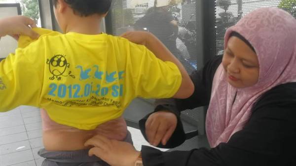 Siti Satariah menunjukkan bahagian kulit badan anaknya yang melecur.