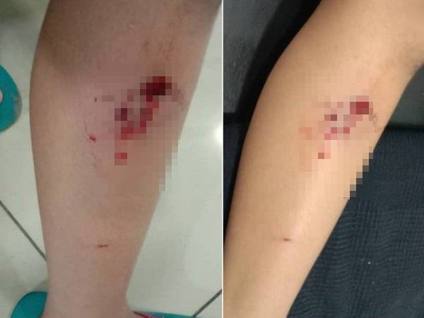 Keadaan kaki Syaifulamerulrezal ketika digigit anjing di Jalan TK5/24 malam Isnin lalu.