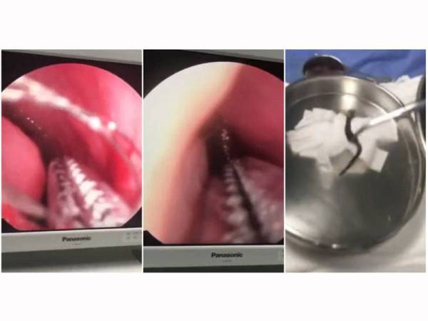 Rakaman video menunjukkan Dr Wang menyembur anestetik ke dalam lubang hidung pesakit dan mengeluarkan lintah sepanjang 3.15 inci.