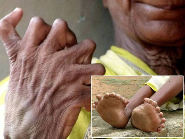 Kumar Nayak mempunyai 20 jari kaki dan 12 jari tangan.