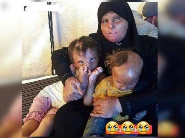 Gambar yang memaparkan kanak-kanak yang cacat akibat bahan kimia fosfor putih sehingga boleh menyebabkan kulit mereka terbakar yang dilakukan oleh Israel.
