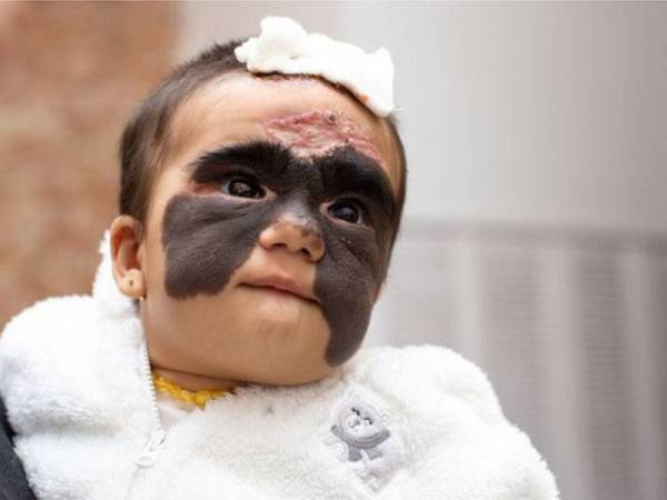 Luna selepas pembedahan.