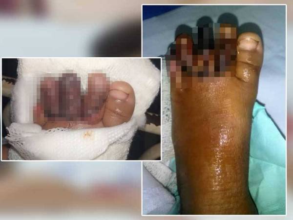 Keadaan kaki Muhammad Ammar Qayyum selepas menerima rawatan akibat dihempap papan tanda masjid pada 23 November lalu. Gambar kanan: Keadaan terkini kaki kanak-kanak terbabit. - Foto ihsan keluarga mangsa