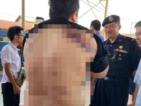 Antara kecederaan yang dialami mangsa setelah diserang sekumpulan individu dalam kejadian kelmarin.