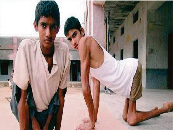 VIRUS polio yang menyerang saraf memberi kesan ketara terhadap anggota tubuh badan