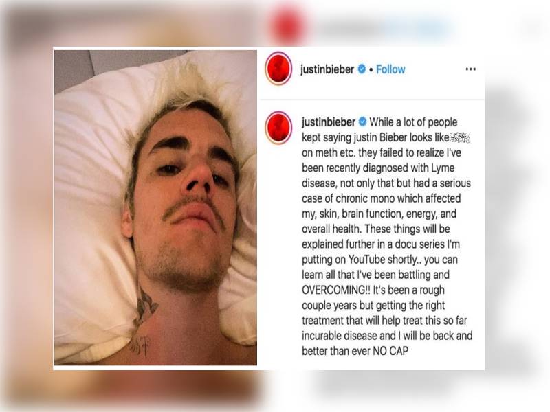 Perkongsian gambar selebriti terkenal itu kini tular di media sosial dan rata-rata netizen bersimpati dengan penyakit yang dihidapi Bieber.