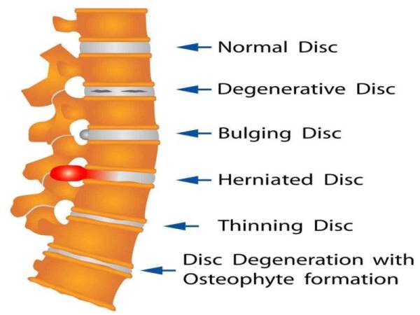 STRUKTUR disc pada tulang belakang manusia.