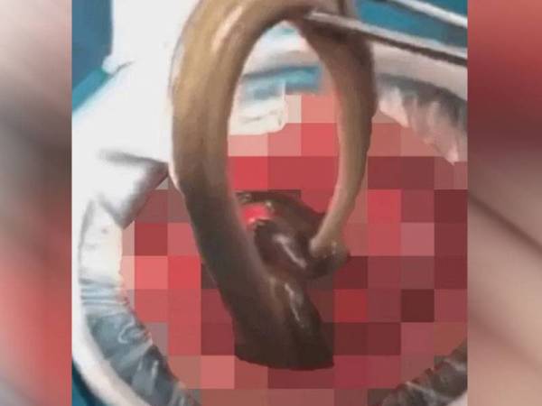 Kedua-dua belut tersebut berjaya dikeluarkan dan lelaki tersebut telah dibenarkan keluar daripada hospital.