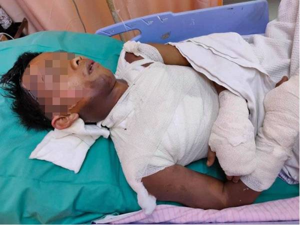 Mangsa melecur sebahagian badan dan patah jari telunjuk kanan kini menerima rawatan di Hospital Mersing. - Foto Zubaidah Jumaat