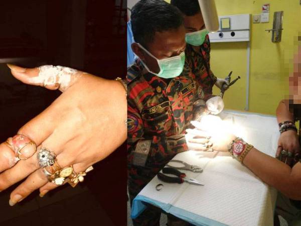 Keadaan jari tangan mangsa yang bengkak akibat memakai sebahagian cincin berkenaan. Anggota bomba ketika cuba memotong cincin dipakai mangsa berkenaan.