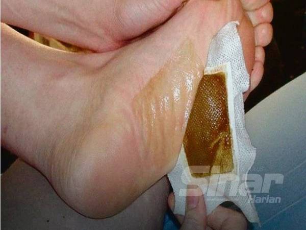 PAD pada kaki yang bertukar warna dikatakan akibat toksik keluar dari tubuh.