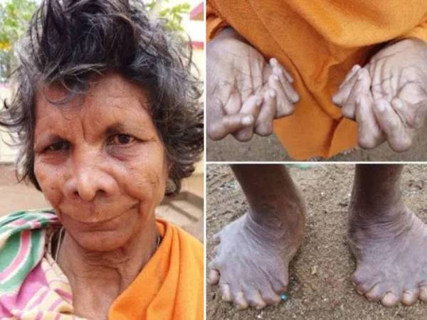 Nayak terpaksa berkurung di dalam rumah selepas digelar ahli sihir oleh jirannya hanya kerana dilahirkan dengan 31 jari tangan dan kaki.