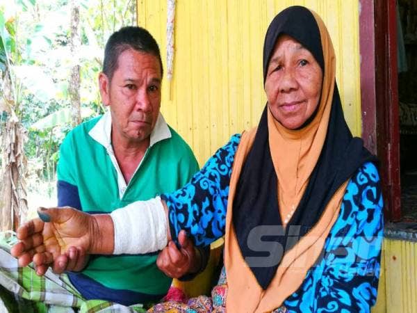 Sitah (kanan) menunjukkan tangan kanannya yang dikelar penyamun. 