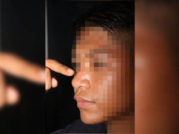 Anggota polis yang mengalami keretakan pada tulang hidung akibat bergelut dengan suspek.