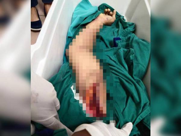 Lengan kanan mangsa terputus selepas tersepit pada mesin.