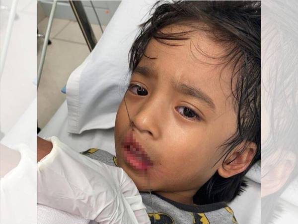 Keadaan Zayyan sebelum pembedahan.