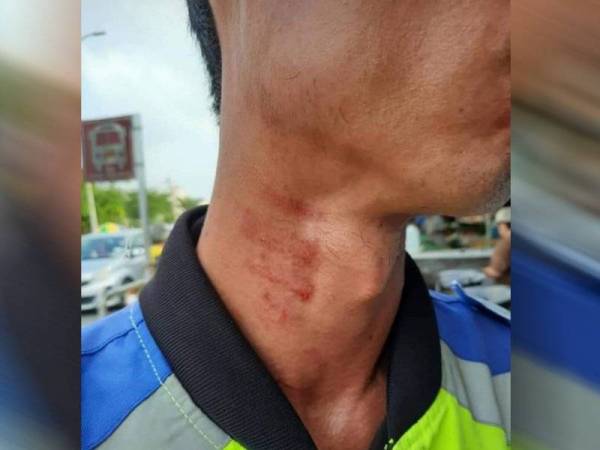 Kesan lebam pada leher mangsa.