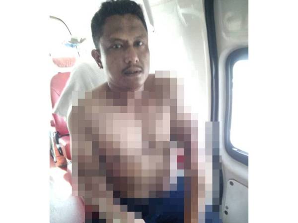 Mangsa yang melecur dibawa ke Hospital Sultanah Bahiyah Alor Setar untuk rawatan susulan. - Foto JBPM Kedah