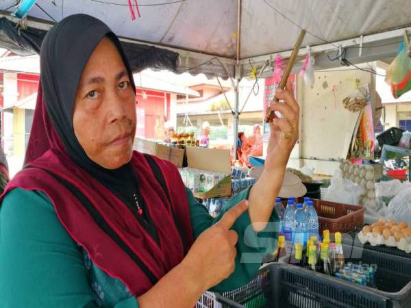 Kesan lebam di kawasan pergelangan tangan Che Minah selepas dua utas gelang miliknya disamun.