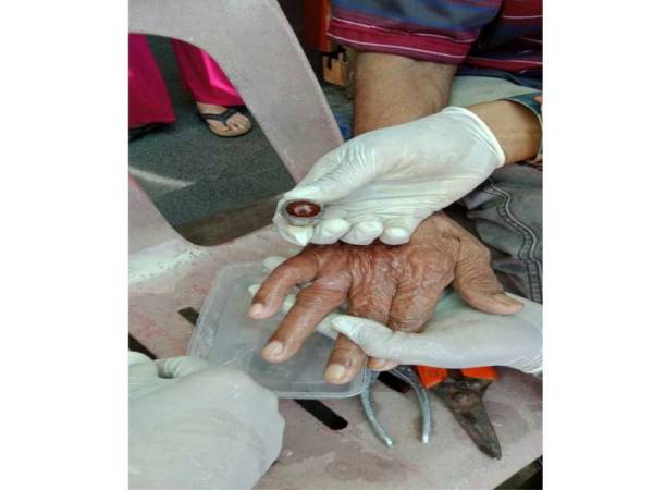 Anggota bomba berjaya memotong cincin yang tersekat pada jari seorang lelaki warga emas selepas tersangkut hingga mengakibatkan jarinya bengkak.