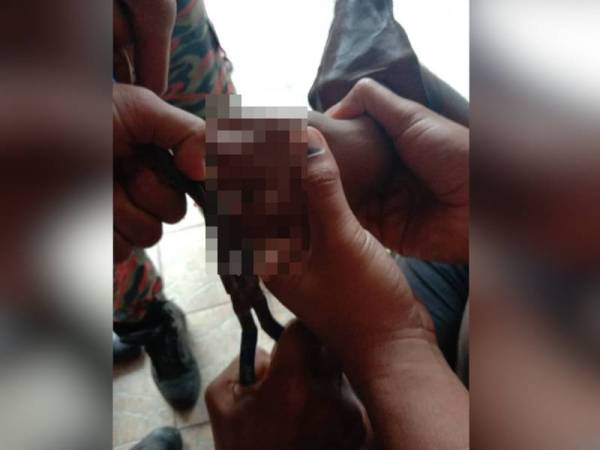 Jari kanak-kanak lelaki tersepit pada spring tilam di Taman Mutiara, Kulim hari ini.