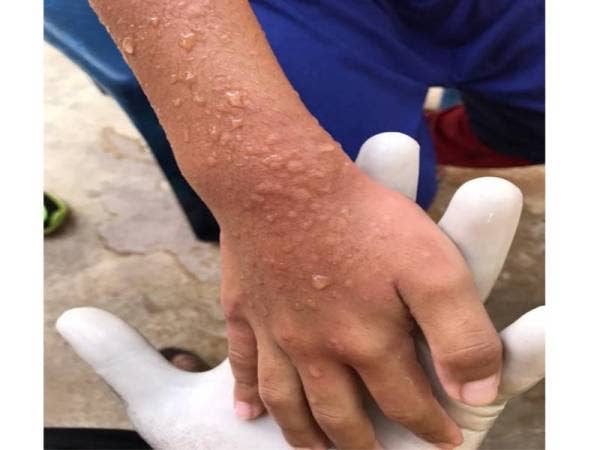 Anggota badan terkena obor-obor akan menjadi merah dan gatal. - Foto APM Besut