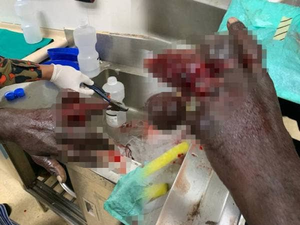 Keadaan jari lelaki itu selepas tersangkut cincin dalam kejadian awal pagi tadi.