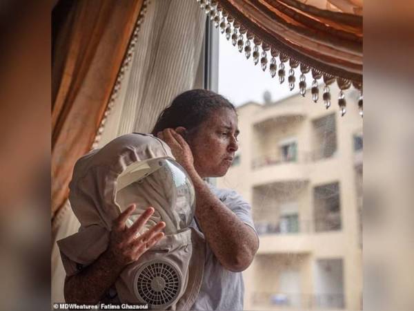 Fatima tidak keluar pada siang hari selama lebih dari 20 tahun dan perlu memakai pelindung setiap hari iaitu topi keledar NASA, sarung tangan. - Foto Daily Mail