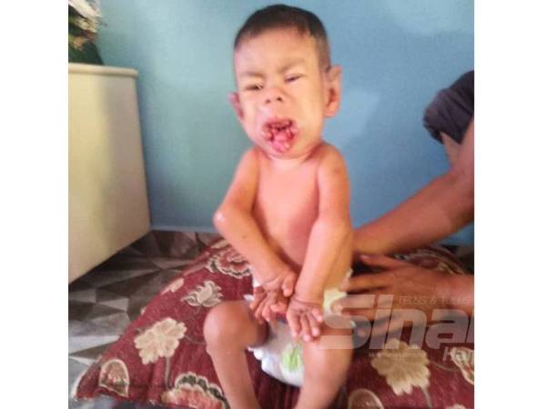 Muhammad Aqil Aqma yang masih kecil terpaksa menanggung penderitaan akibat ketumbuhan di mulut sejak usia tiga bulan.