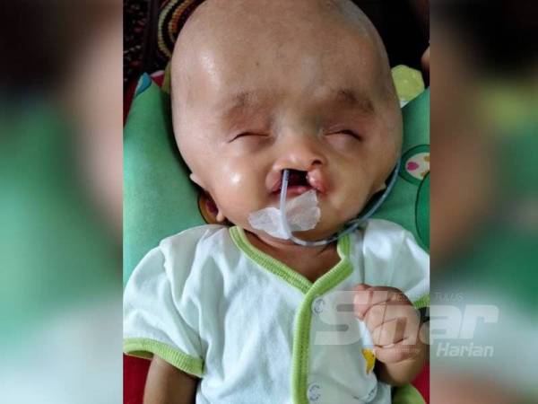 Keadaan Mohammad Bilal Yusra yang dilahirkan dengan keadaan kepala membesar dan sumbing di mulut serta hidung.