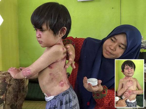 Norazilawani menyapu ubat pada anaknya, Muhammad Faris Amsyar yang menderita penyakit Epidermolysis Bullosa (EB) atau dikenali sebagai kulit rapuh sejak lahir ketika ditemui pemberita di kediaman di Kampung Teluk Kintang, Pengkalan Chepa hari ini. - Foto Bernama