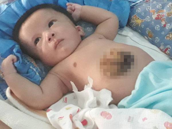 Muhammad Ammar menghidap penyakit hati di luar (extracorporeal liver).