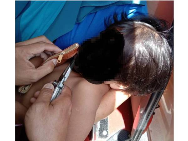 Zip dompet terlekat pada celah gigi kanak-kanak perempuan berusia empat tahun di Bagan Serai pada Jumaat. Foto: ihsan bomba
