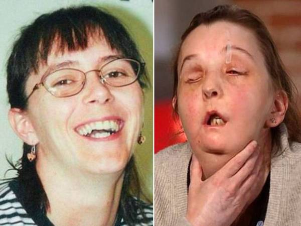 Gambar Tarleton sebelum mengalami kecacatan pada wajah.- Foto Daily Mail Gambar kanan: Gambar Tarleton selepas lakukan pemindahan muka kali kedua. - Foto Daily Mail