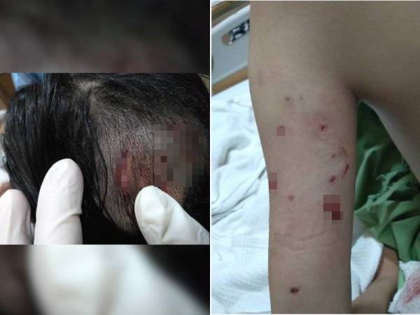 Keadaan luka di kepala dan lengan Syauqina selepas diserang anjing dalam kejadian tersebut.