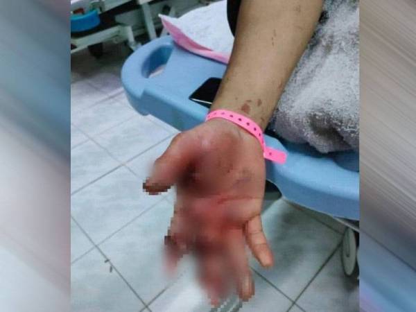 Seorang remaja hilang jari telunjuk dan tengah sebelah kanan selepas terkena letupan mercun bola dalam kejadian Kampung Banggol Kulim, Rantau Panjang pada Sabtu. - Foto Ihsan pembaca