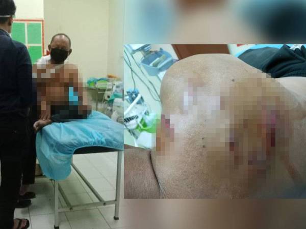 Kasturi ketika menerima rawatan akibat digigit buaya dalam kejadian di kawasan laut berhampiran Sungai Gadong, Beaufort. Kesan luka di bahagian belakang dan bahu kanan Kasturi akibat digigit buaya dalam kejadian di kawasan laut berhampiran Sungai Gadong, Beaufort.