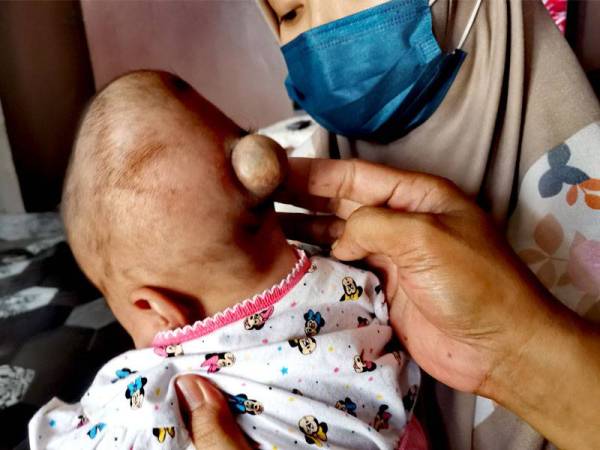 Tempurung kepala Nur Fatima yang perlu dibedah kerana otaknya terkeluar.