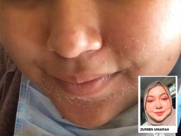 Kulit wajah Zureen Umairah ketika memakai produk komestik mengandungi racun berjadual.