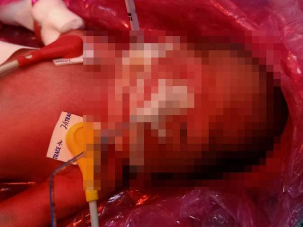 Bayi lelaki yang ditemui di bawah kolong rumah dirawat di Hospital Lahad Datu.